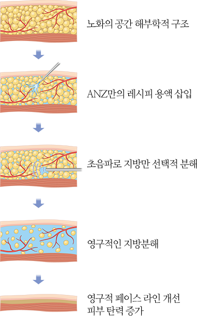 노하우 1. 노화의 공간 해부학적 구조 2. ANZ만의 레시피 용액 삽입 3. 초음파로 지방만 선택적 분해 4. 영구적인 지방분해 5. 영구적 페이스 라인 개선 피부 탄력 증가