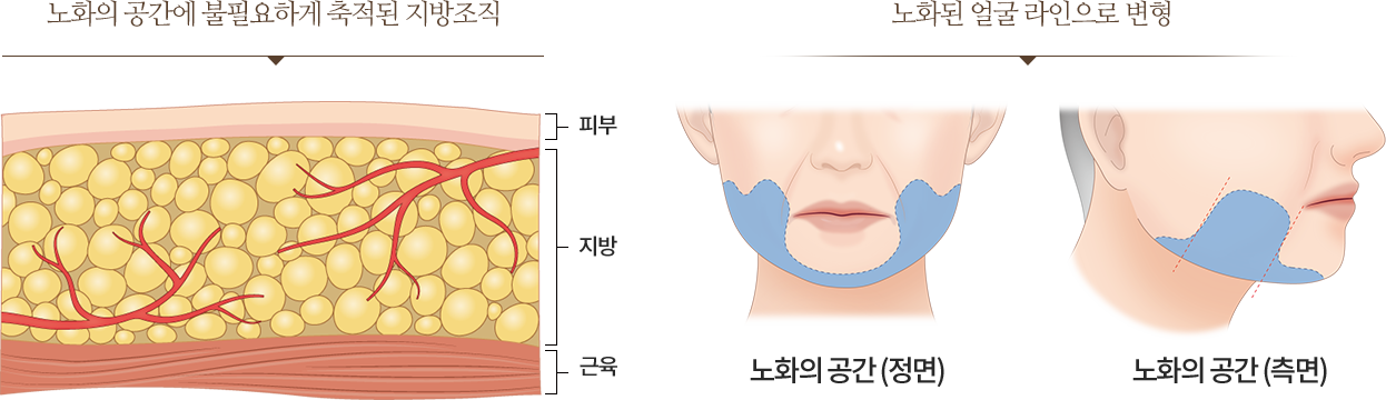 티타늄 SHR MODE & STACK MODE 3파장 레이저 리프팅 + 타이트닝 + 화이트닝 세가지 효과 / 써마지 THERMAGE 피부 속 콜라겐을 재생 주름개선 효과